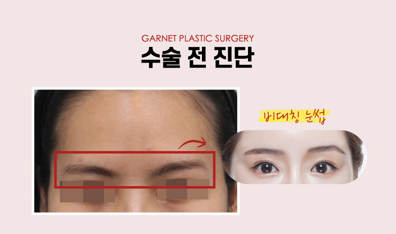 【Garnet Plastic Surgery Director Baek In-soo’s Plastic Surgery Column】 Improving Brow Ptosis with a Pentafix Forehead Lift in One’s 20s image 3