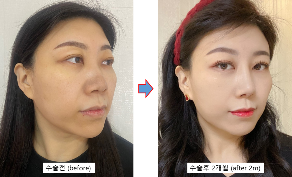 Rhinoplasty + Forehead Fat Grafting: Why the Face’s Mood Changes image 3