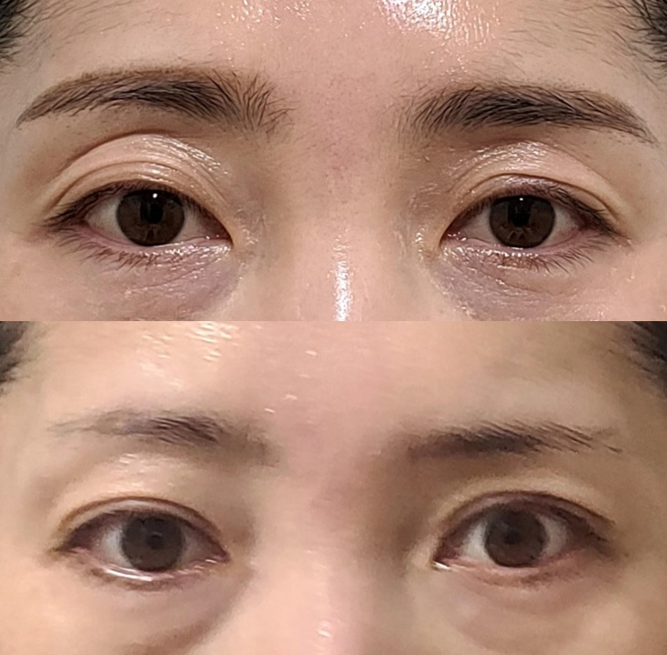 How to Address Double Eyelids and Hollow Eyes by Improving Both the Line and Volume image 6