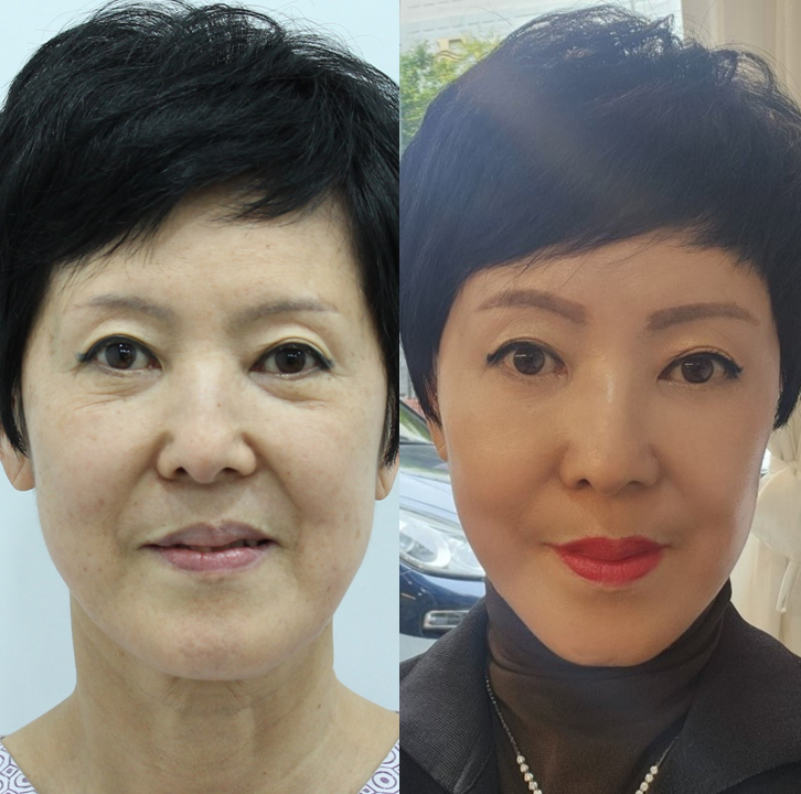 자연스러운 안면거상의 최종결과 관련 이미지 6