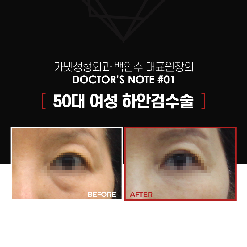 【Garnet Plastic Surgery Director Insoo Baek’s Plastic Surgery Column】 Lower Blepharoplasty Case in a Woman in Her Late 50s image 2