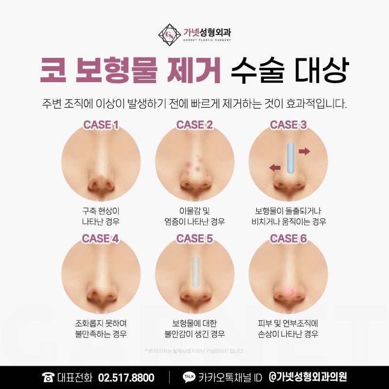 코실리콘제거비용 보다 중요하게 알아 봐야 할 것은? 관련 이미지 3