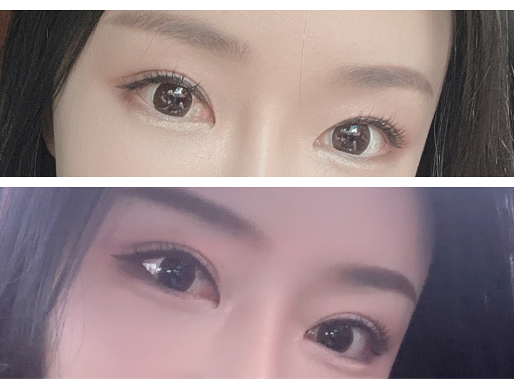 Double Eyelid Surgery and Ptosis Correction image 8