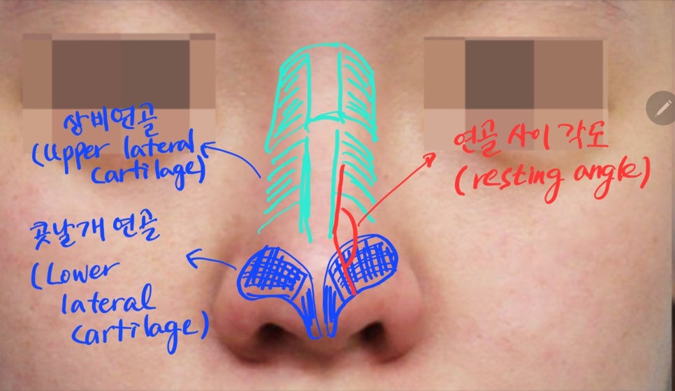 Various Nasal Tip Procedures for Bulbous Nose Correction image 3