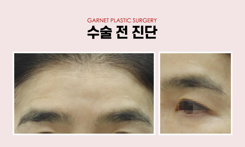 압구정역성형외과에서 알아보는 대표적인 동안성형 종류! 관련 이미지 9