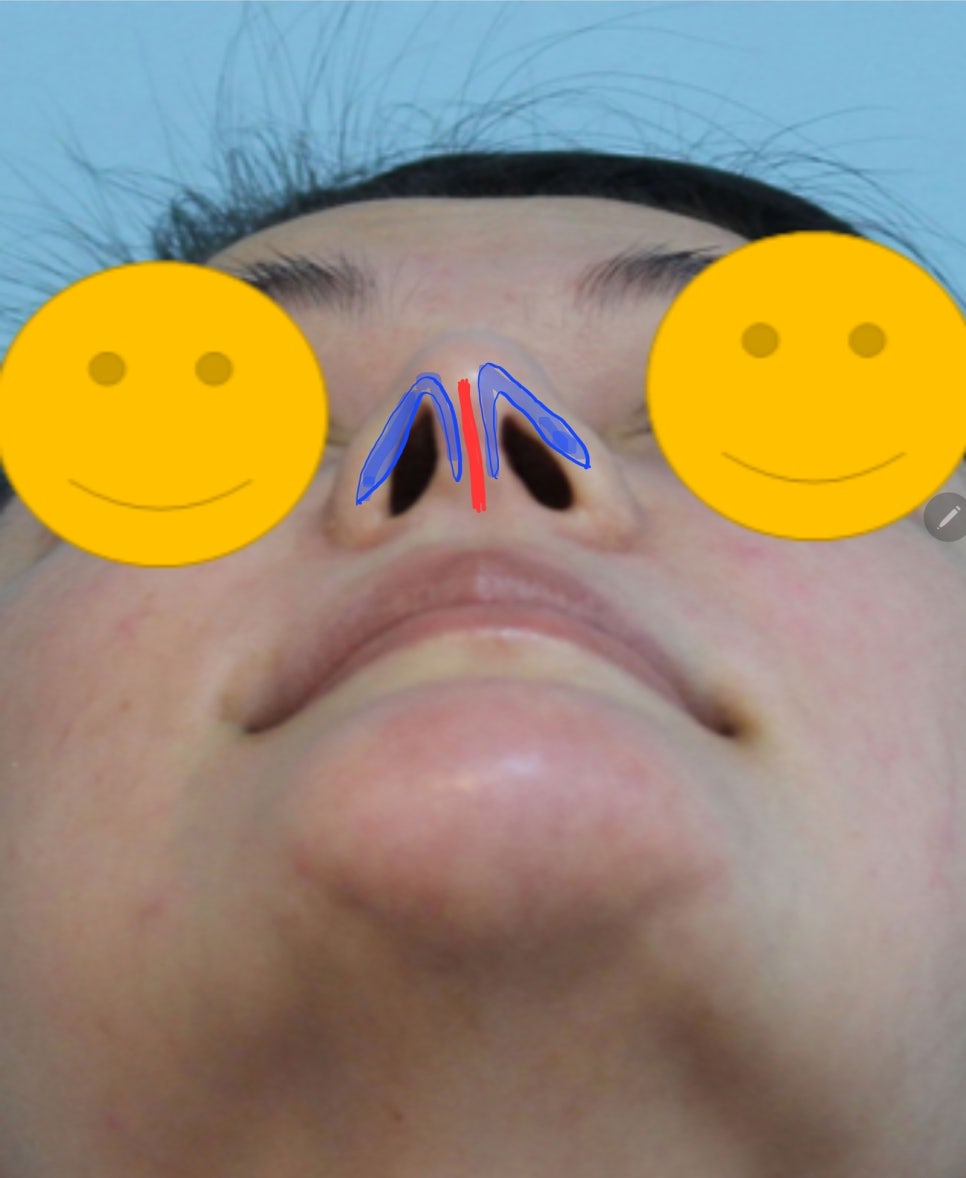 안면비대칭에서 코성형의 중요성 관련 이미지 3
