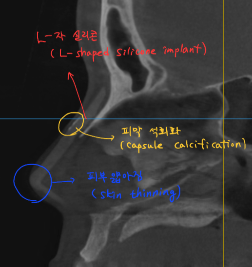 Information You Can Obtain Through CT Scanning During a Consultation for Revision Rhinoplasty image 2
