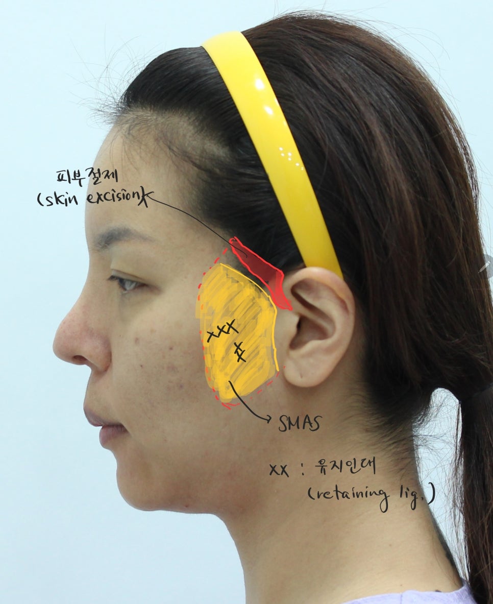 다이어트후 발생한 얼굴의 노화 관련 이미지 5