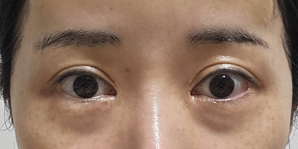 눈밑지방재배치, 앞볼 리프팅이 필요한 경우 관련 이미지 1