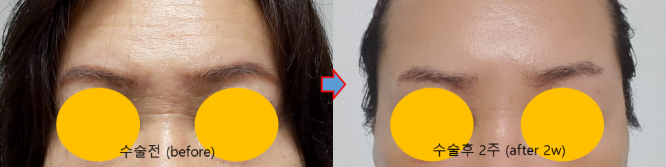 콧등 가로주름과 이마거상에서 중요한 고정포인트 관련 이미지 5