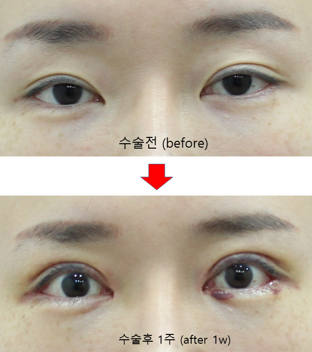Double Eyelid Surgery and Ptosis Correction image 6