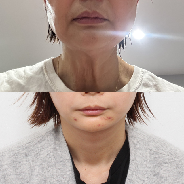 턱끝성형과 함께하는 펠리컨수술 관련 이미지 6