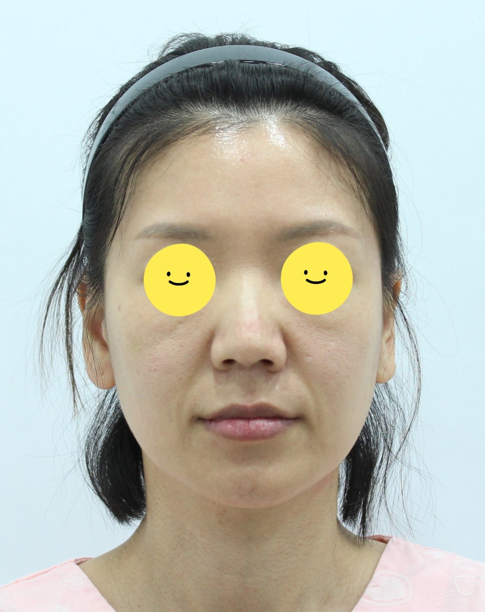 Recovery Period for Midlife Nose Surgery image 1