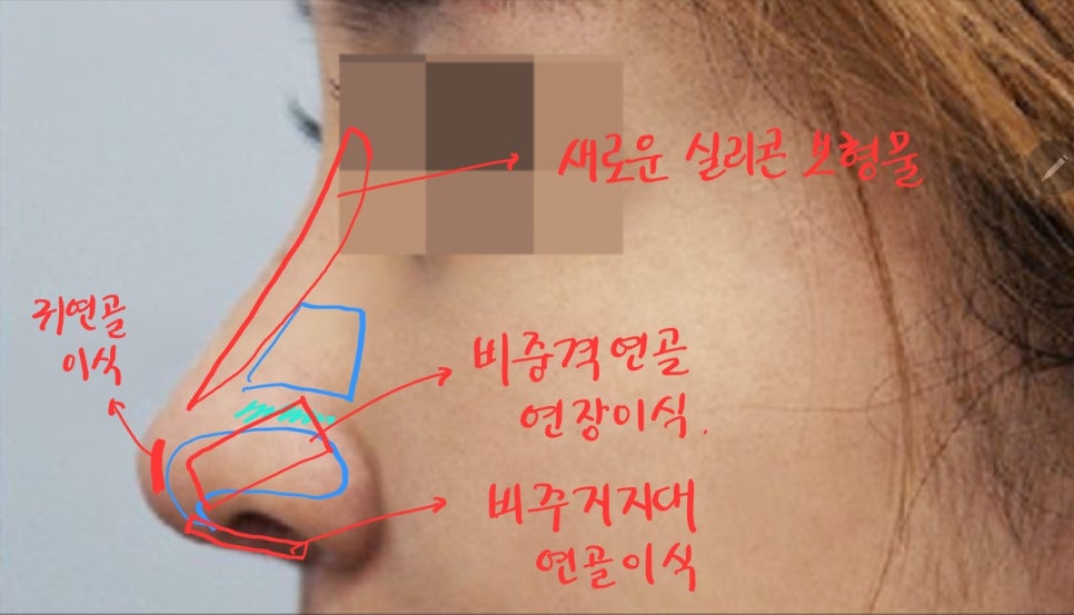 Lengthening Revision Rhinoplasty for a Short, Upturned Nose image 4