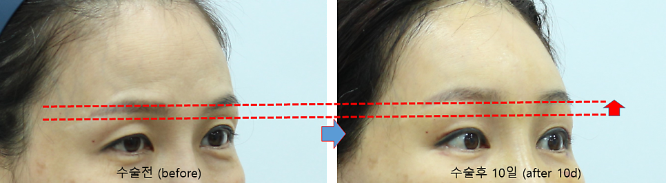 Forehead Lift to Correct Eyebrow Asymmetry image 8