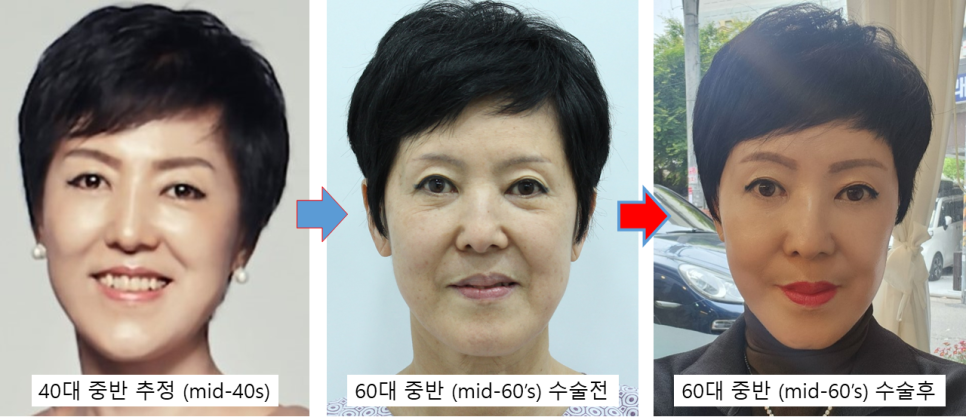 자연스러운 안면거상의 최종결과 관련 이미지 5
