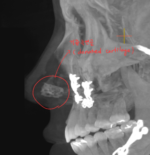 Information You Can Obtain Through CT Scanning During a Consultation for Revision Rhinoplasty image 7