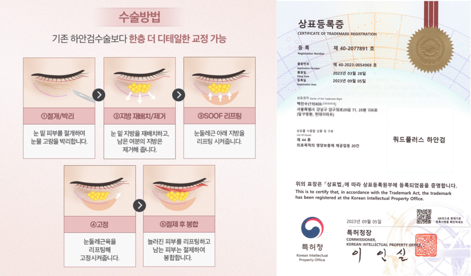 하안검 수술, 어디까지 변화하고 있을까? 관련 이미지 1