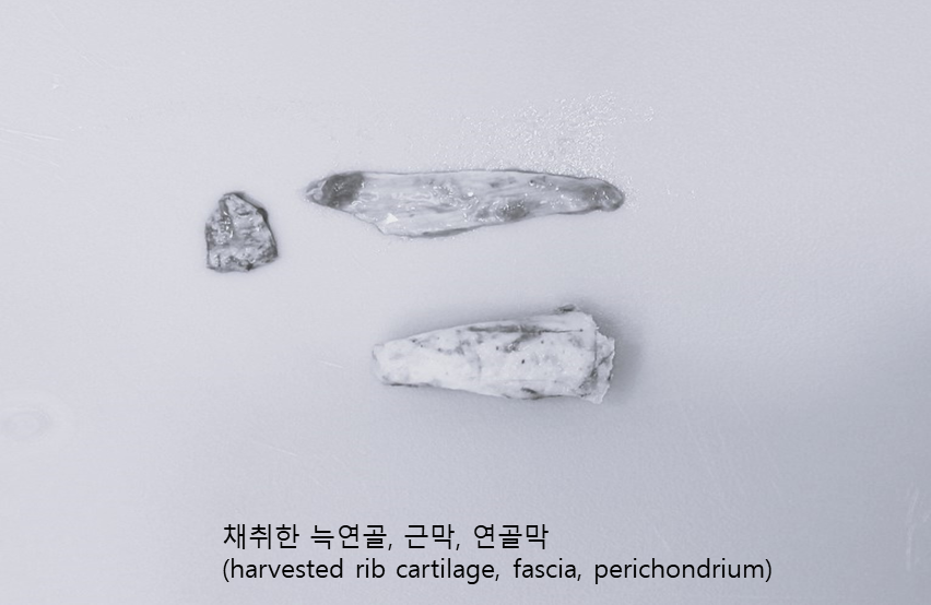 Rhinoplasty for Zainichi Koreans, Rhinoplasty for Japanese Koreans image 4