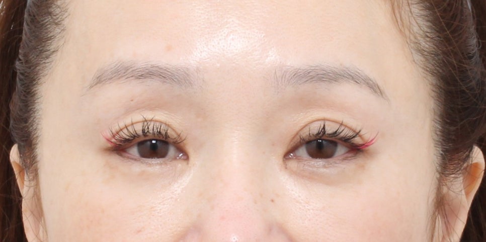 중년눈성형에서 눈매교정이 필요한 경우 관련 이미지 2