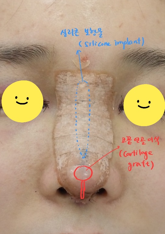Treatment Process to Speed Recovery After Rhinoplasty image 5