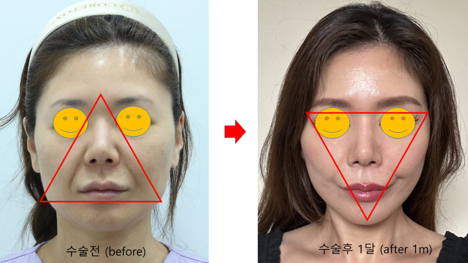 노화에 따른 얼굴형의 변화 관련 이미지 5