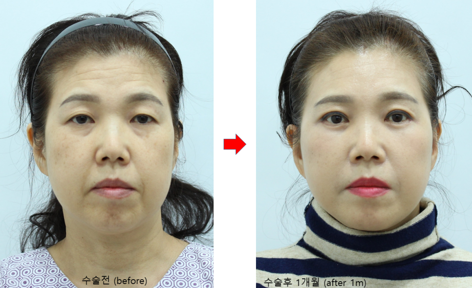중년종합성형 상담과 수술의 범위 관련 이미지 4