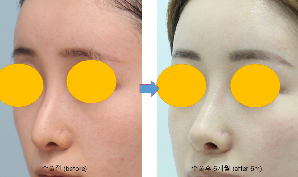 Consultation Process and Surgical Items for Revision Rhinoplasty image 9