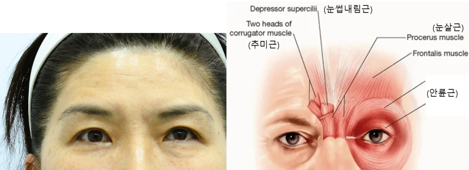 미간주름의 원인과 치료 관련 이미지 2