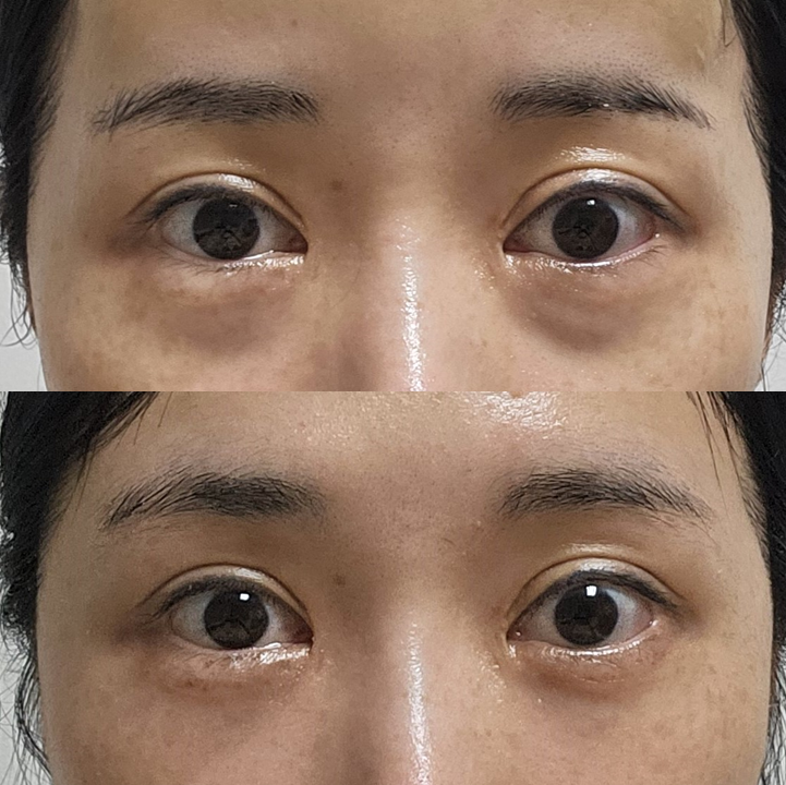 눈밑지방재배치, 앞볼 리프팅이 필요한 경우 관련 이미지 6