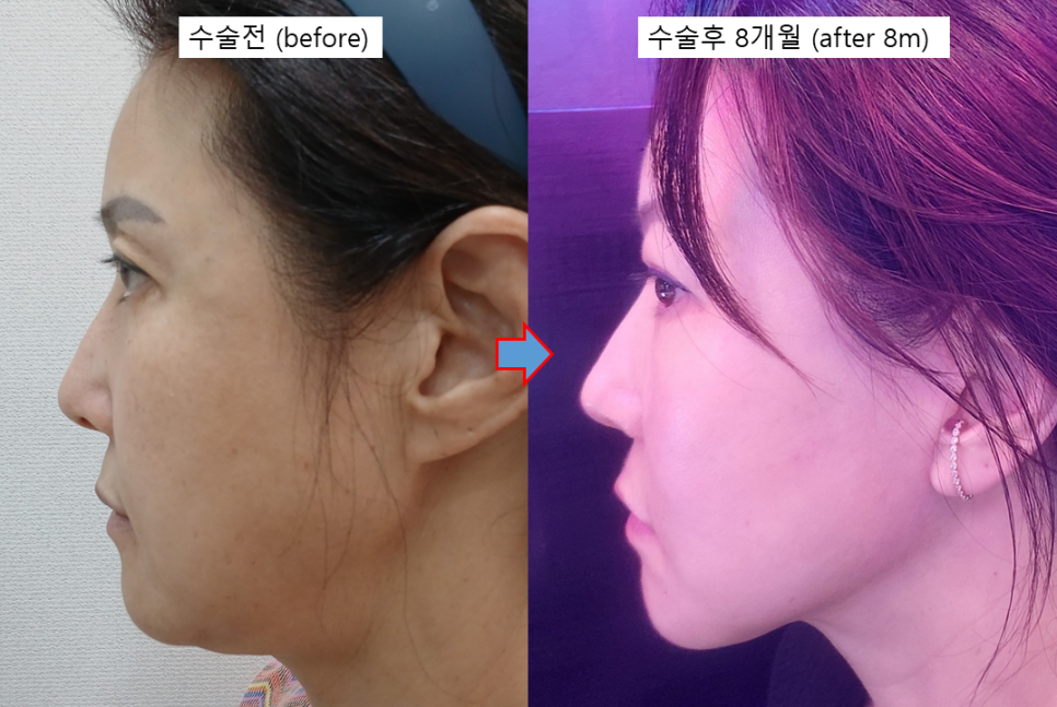 안면거상의 완성도를 높이는 펠리컨 수술 관련 이미지 5