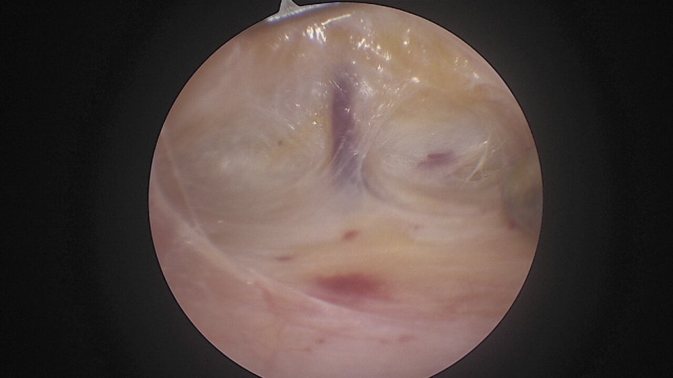 Forehead Lift to Correct Eyebrow Asymmetry image 3