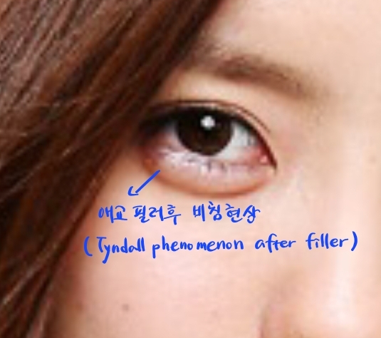 애교살 미세 지방이식의 자연스러움 관련 이미지 1