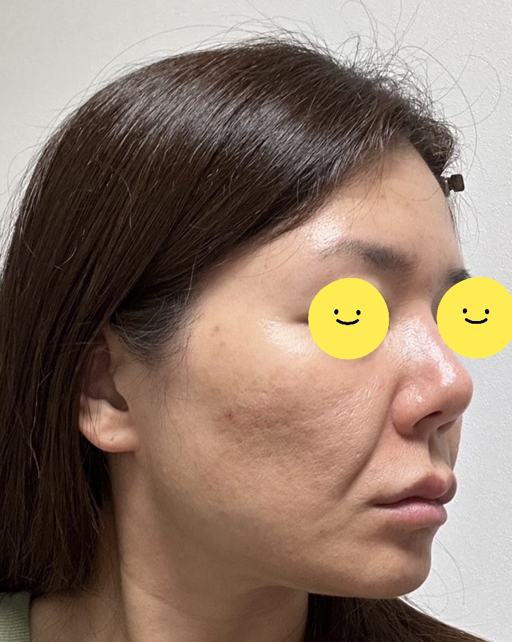 Swelling the Day After a Facelift image 2
