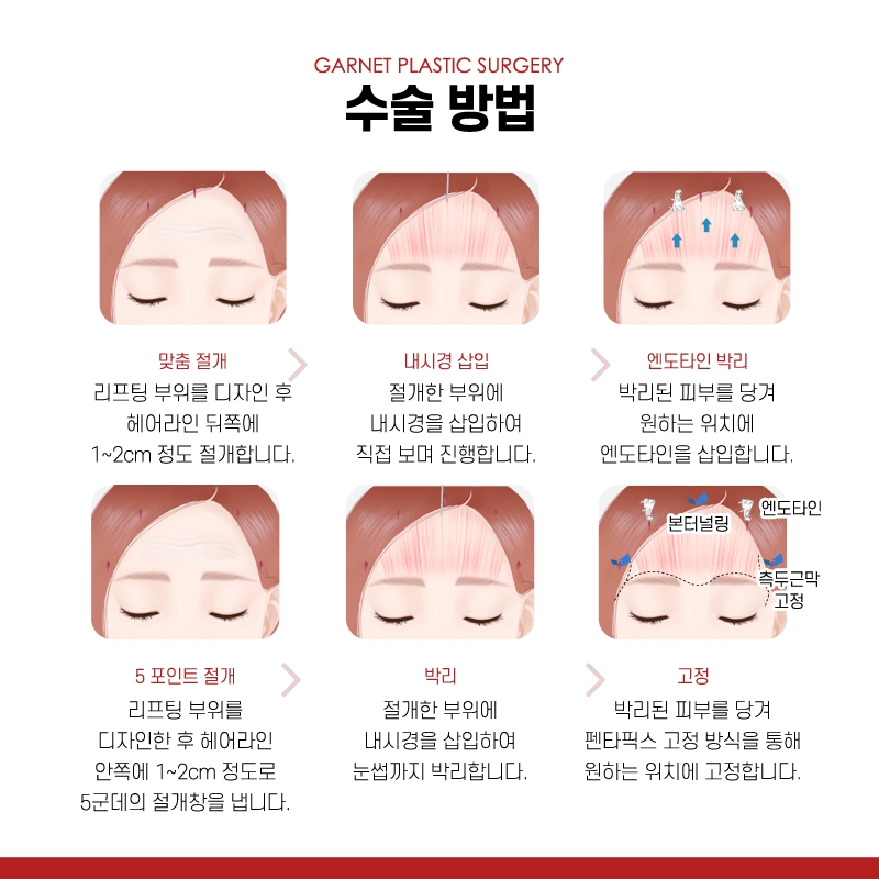 【Garnet Plastic Surgery Director Baek In-soo’s Plastic Surgery Column】 Improving Brow Ptosis with a Pentafix Forehead Lift in One’s 20s image 4