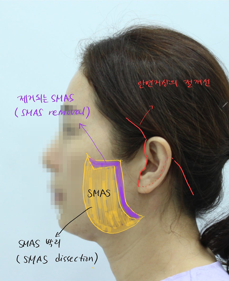 안면거상에서 절개선의 선택방법 관련 이미지 6