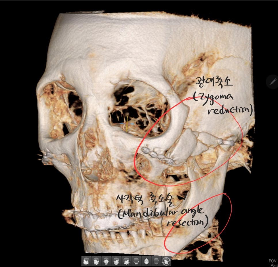 안면윤곽 수술 후 피부처짐의 치료 관련 이미지 2