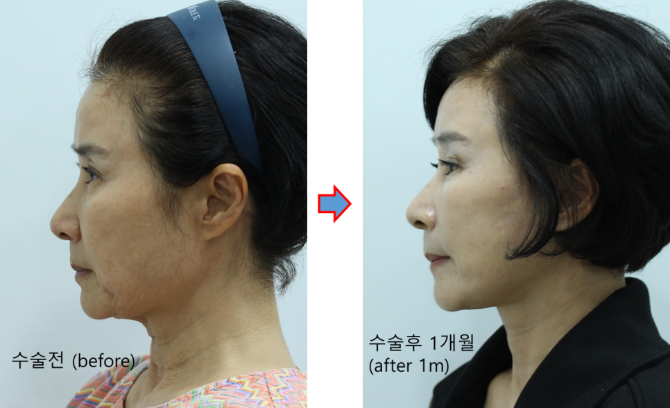 &ldquo;목이 나이를 결정한다: 안면거상과 함께 목거상을 해야 하는 이유&rdquo; 관련 이미지 4