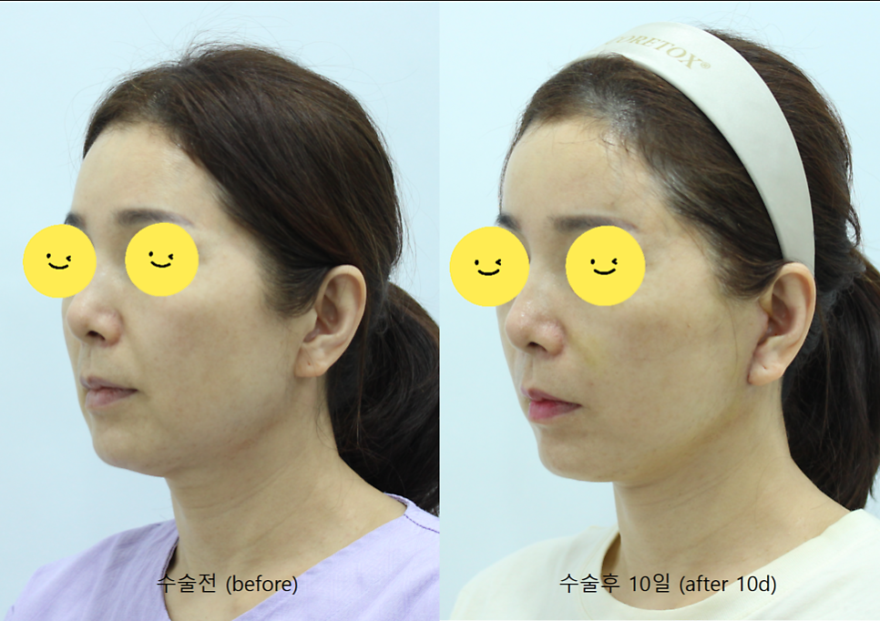 안면거상의 회복기간 관련 이미지 7