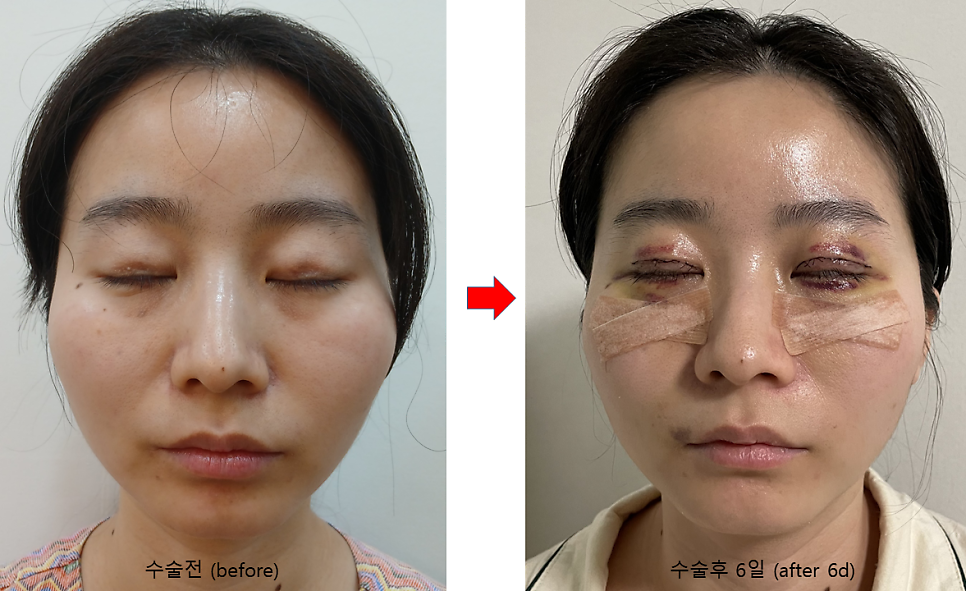 쌍꺼풀 함몰흉터를 교정하는 재수술 관련 이미지 4