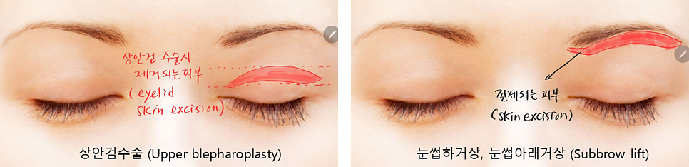 Recovery Process After a Subbrow Lift (Under-Brow Lift) image 1