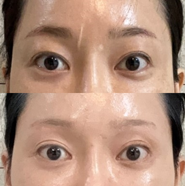흉터성형과 흉터성숙, 시간이 지나면 흉터는 어떻게 변할까요? 관련 이미지 7