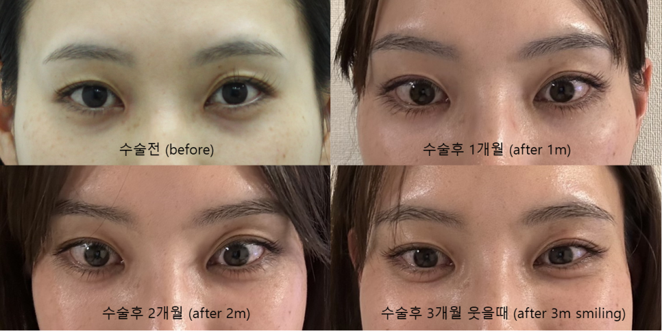 Natural-Looking Under-Eye Fat Repositioning, Even in Facial Expressions: Key Points That Determine the Results image 3