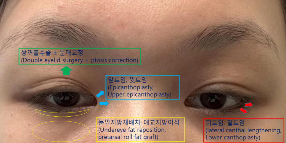 눈성형 종류 총정리, 어떤 수술부터 해야 할까요? 관련 이미지 2