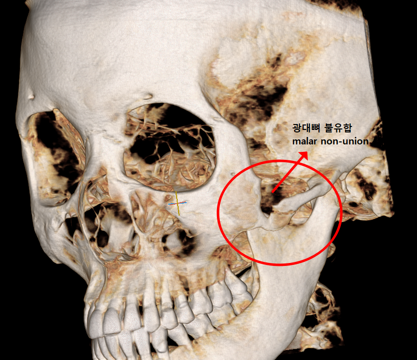 Sagging Skin After Facial Contouring Surgery (Cheek Sagging) image 1