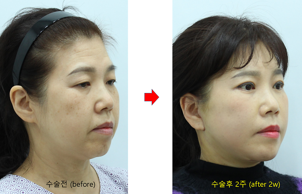 Pre- and Post-Operative Precautions for Faster Recovery After Plastic Surgery image 11