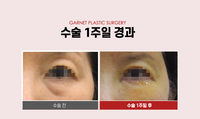【Garnet Plastic Surgery Director Insoo Baek’s Plastic Surgery Column】 Lower Blepharoplasty Case in a Woman in Her Late 50s image 5