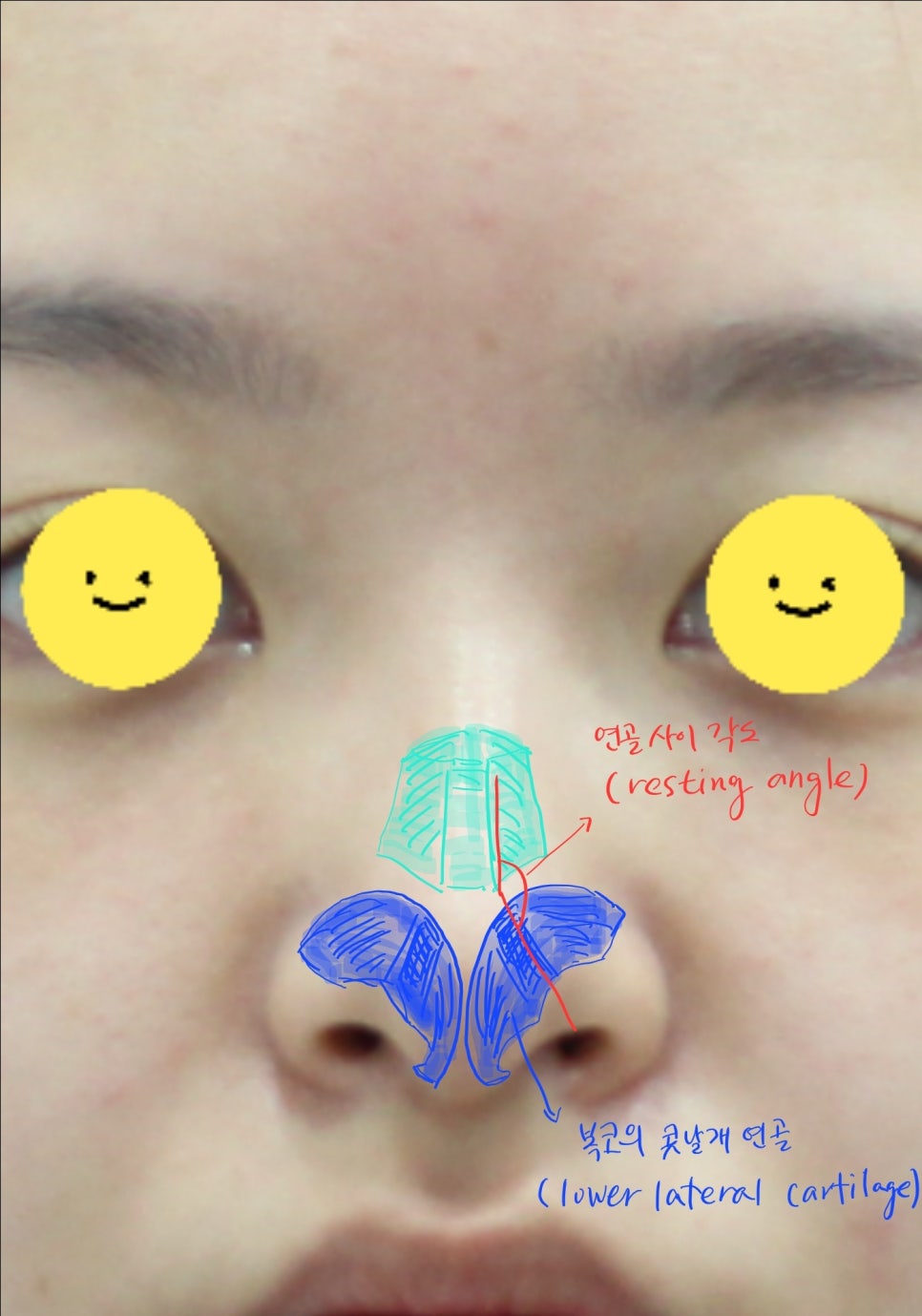 Nasal Tip Remodeling for Bulbous Nose and Drooping Columella Correction image 1