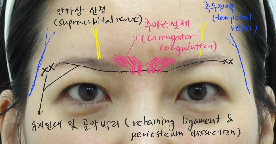 상안검 성형과 이마거상을 함께 했을 때 장점 관련 이미지 5