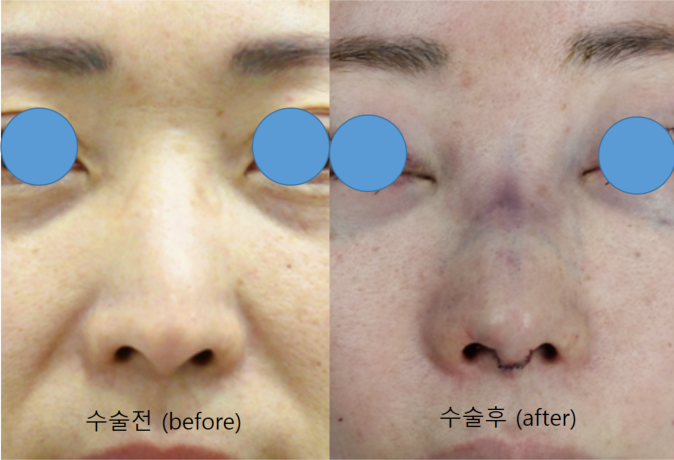 휜코와 동반된 매부리코의 교정 관련 이미지 8